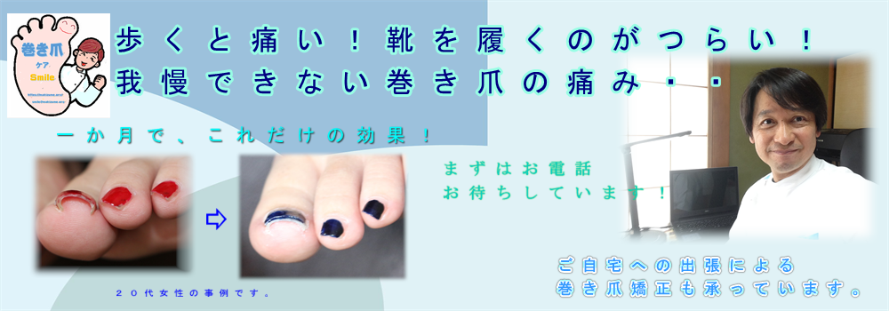 巻爪ケア、痛くない巻き爪矯正ならドイツで生まれたB/S式 さいたま巻き